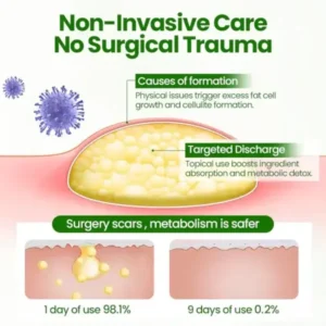 KnotAway Lipoma Removal Cream