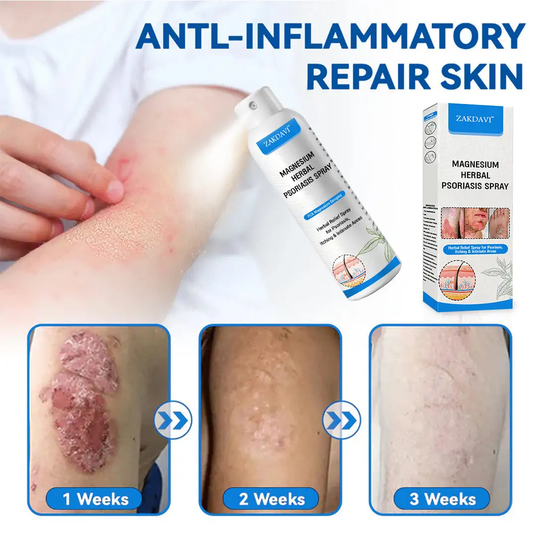 Magnesium Herbal Psoriasis Spray - Image 3