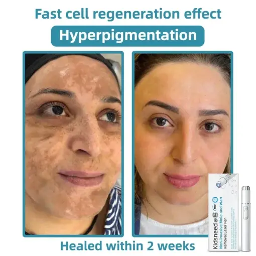 𝑵on-i𝒏va𝒔𝒊ve 𝑴o𝒍e an𝒅 𝑾ar𝒕 𝑹emo𝒗𝒂𝒍 𝑳ase𝒓 𝑷en - Image 11